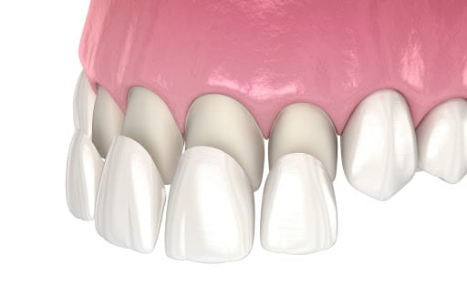 Veneer application