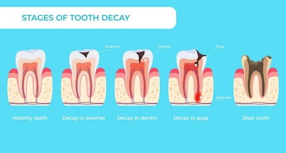 Stages of Tooth Decay Chart