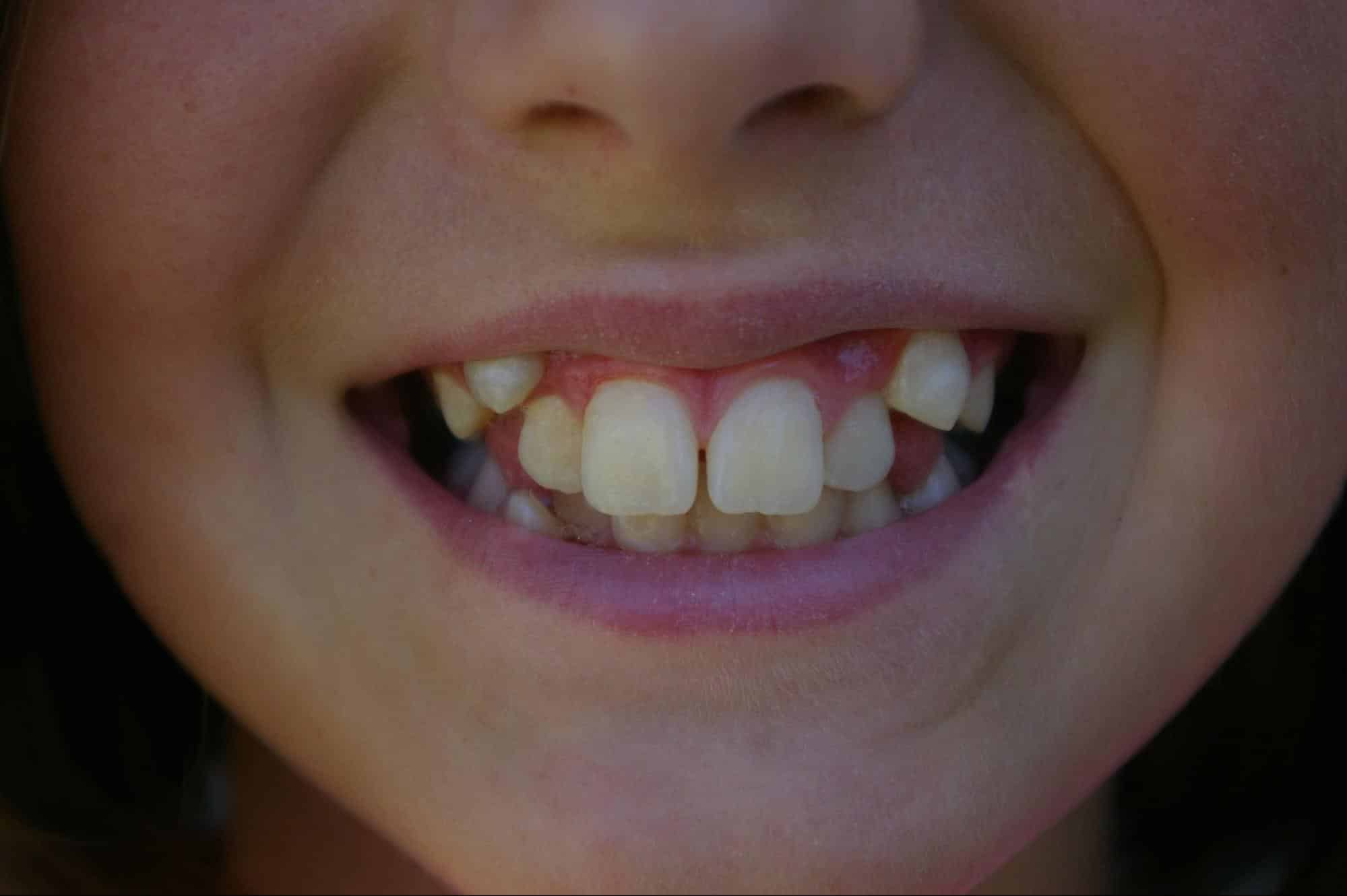 Child who needs braces