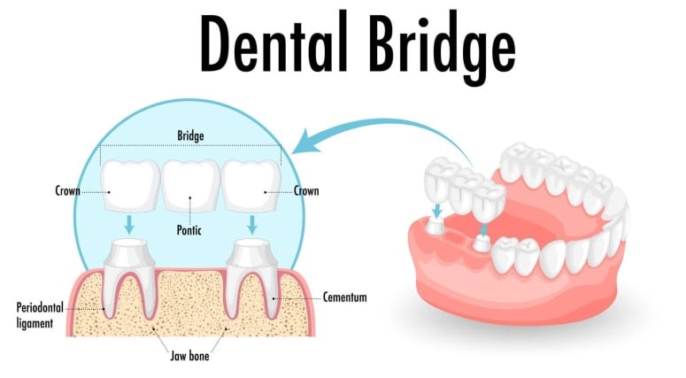 Dental Bridge Diagram