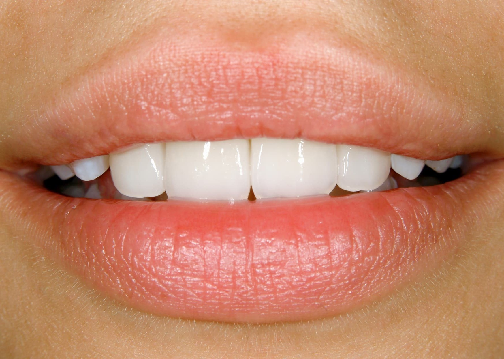 Lady smiling with new porcelain veneers