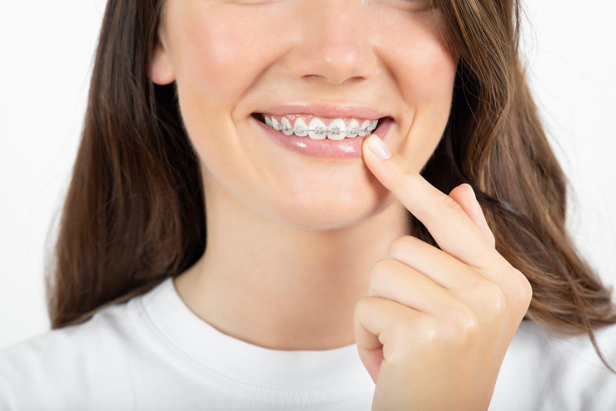 3 Benefits of Braces for Kids