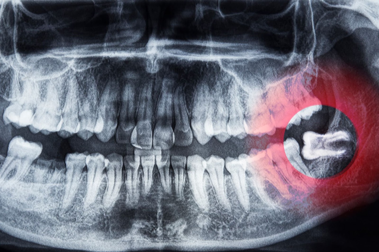 Wisdom Teeth Removal Sparks Extraction Sparks, NV Absolute Dental