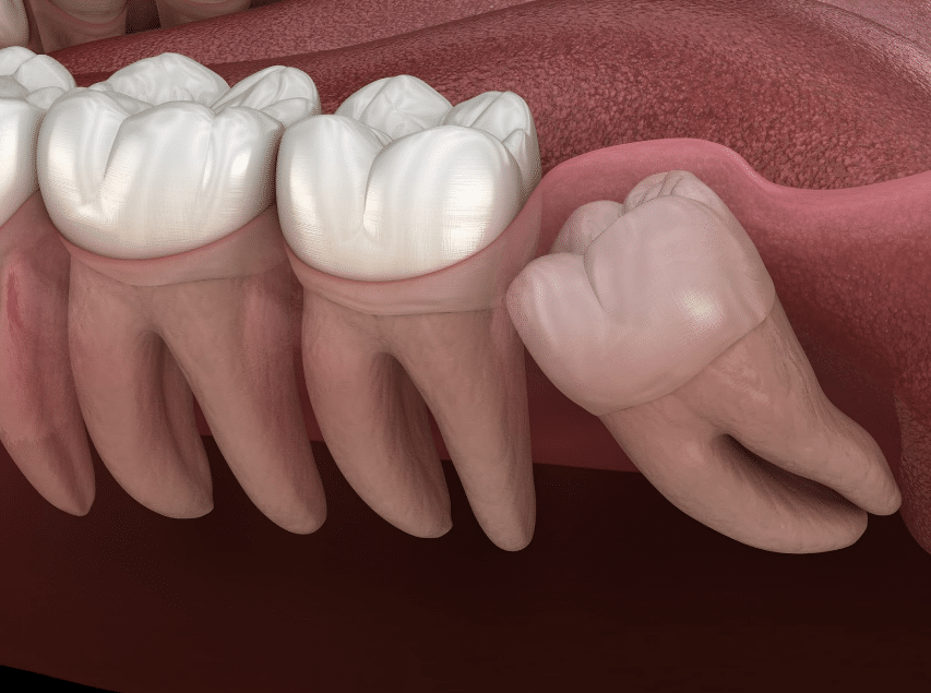 impacted tooth