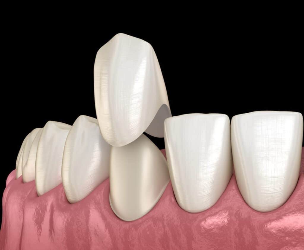 A 3D rendering of a dental crown being placed over a tooth.