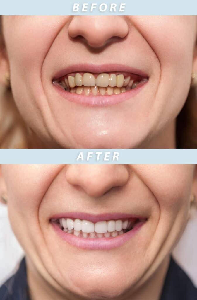 A woman's teeth before and after getting dental crowns.