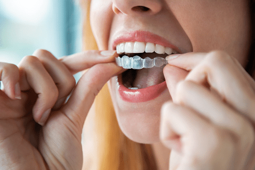 A woman is putting in her clear aligners.