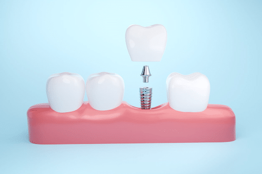 An illustration of a dental implant.