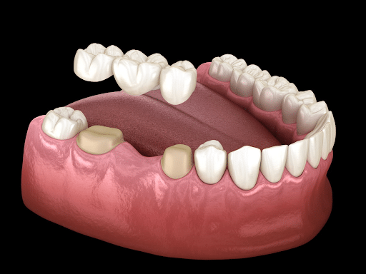 Medically accurate 3D illustration of a dental bridge over three teeth.