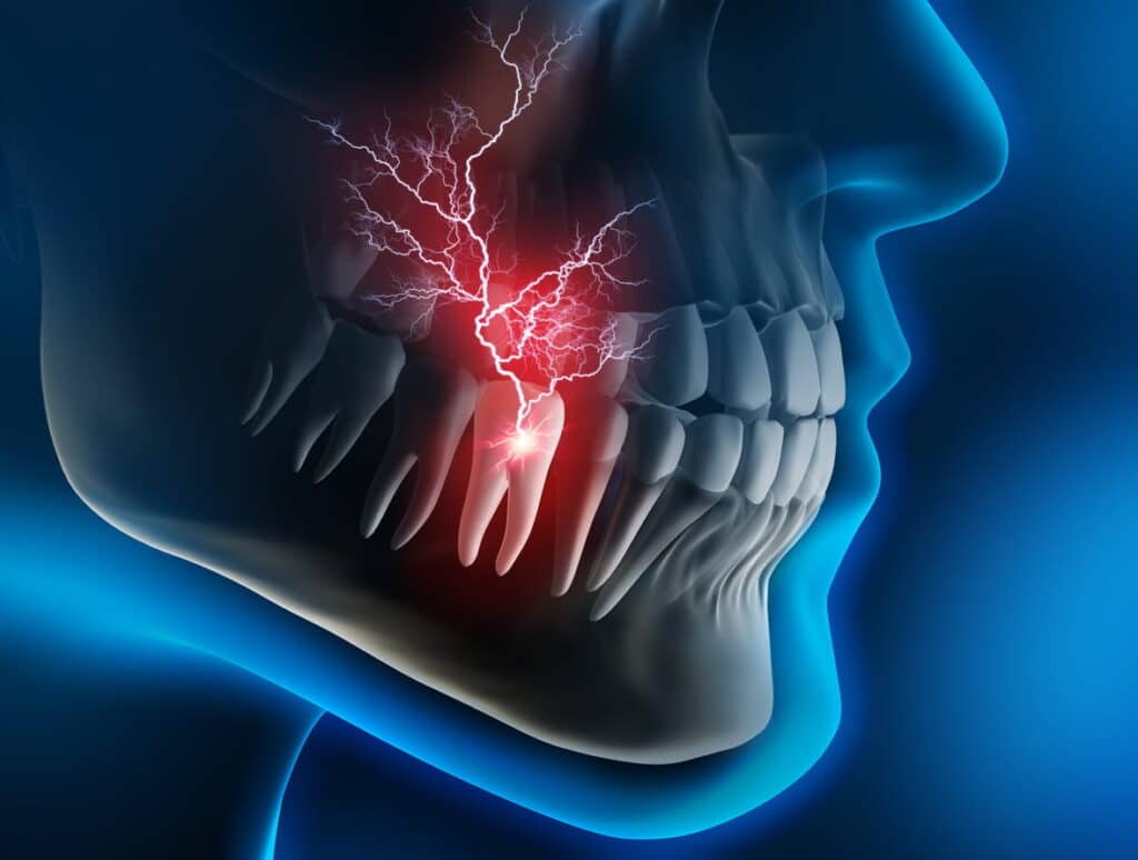 A 3D illustration of wisdom tooth pain shooting up to cause headaches.