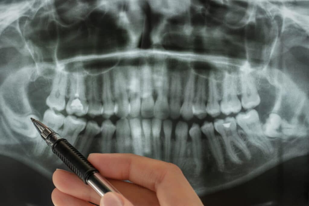 A dentist using a pen to point at a dental X-ray that shows impacted wisdom teeth.