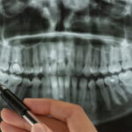 A dentist using a pen to point at a dental X-ray that shows impacted wisdom teeth.