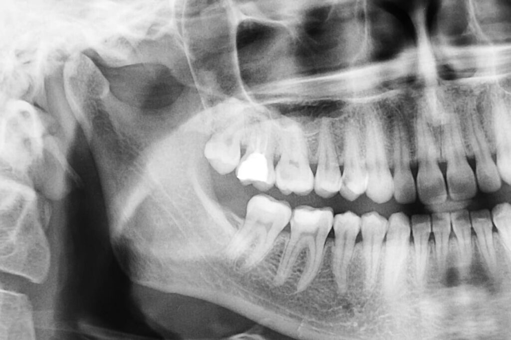 An X-ray of a person's mouth and teeth before oral surgery.