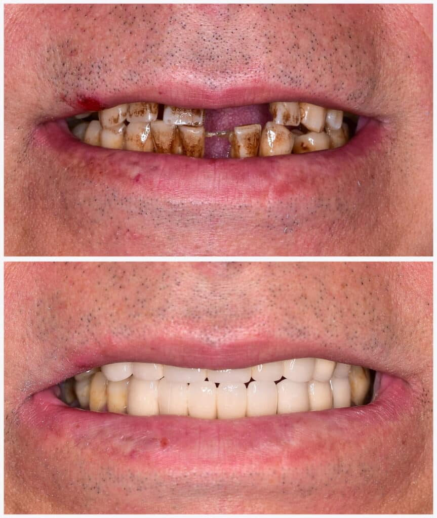 Before and after photo of an individual getting dentures to replace missing teeth.