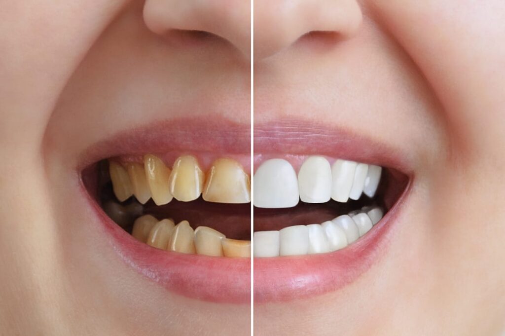 Before and after shots of teeth whitening treatment.
