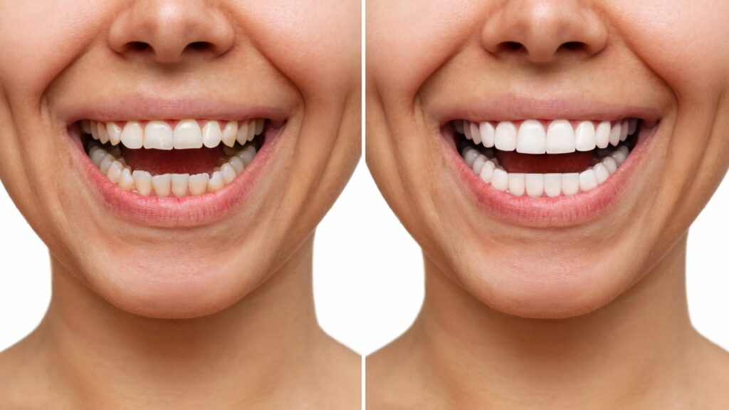 Before and after shots of teeth whitening treatment.