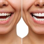 Before and after shots of teeth whitening treatment.