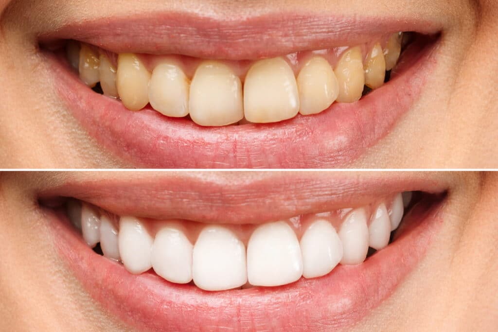 Before and after teeth whitening in Sparks, NV.