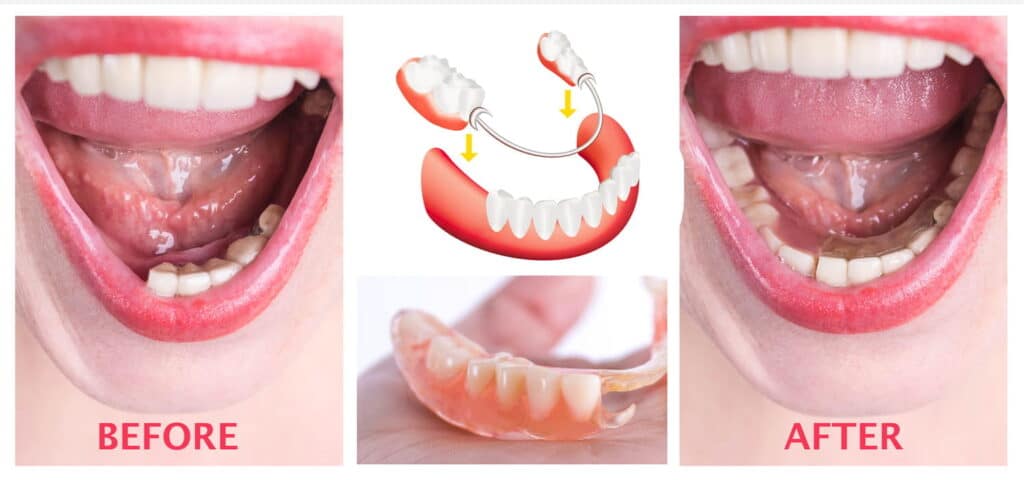 Dentures before and after.