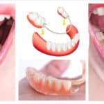 Dentures before and after.