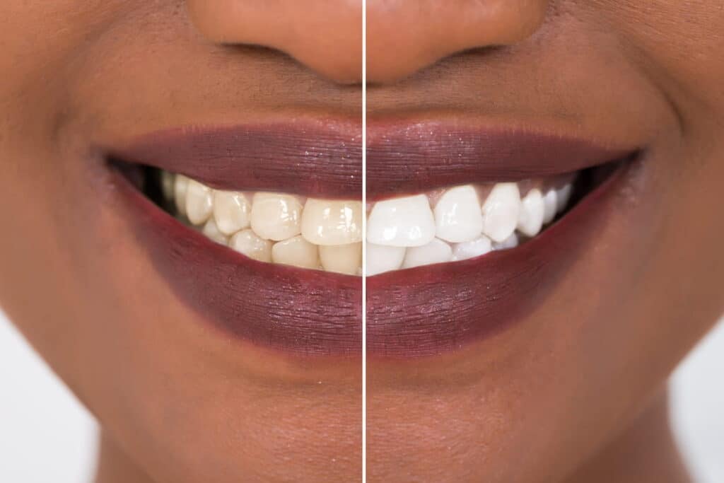 The before and after shot of a woman's smile after receiving a teeth whitening treatment.