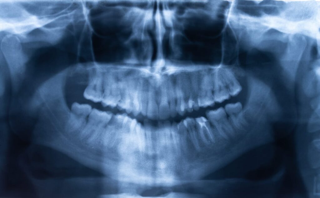 An X-ray of a mouth and teeth before oral surgery.