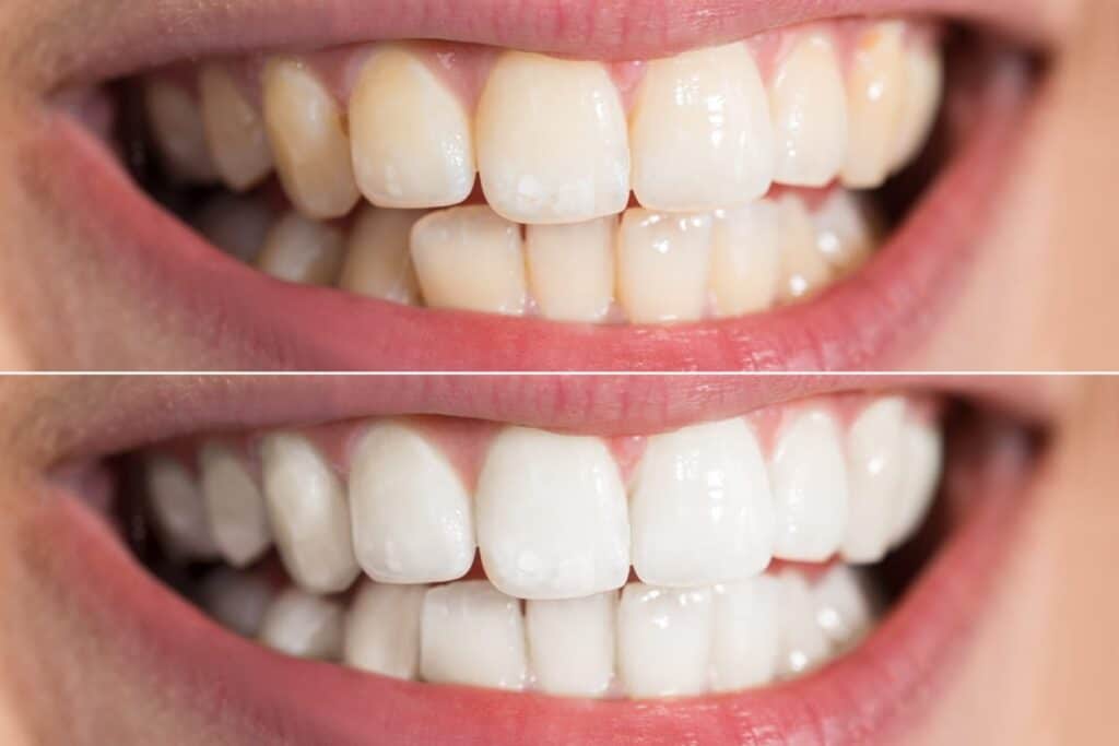 Before and after shots of teeth whitening treatment.