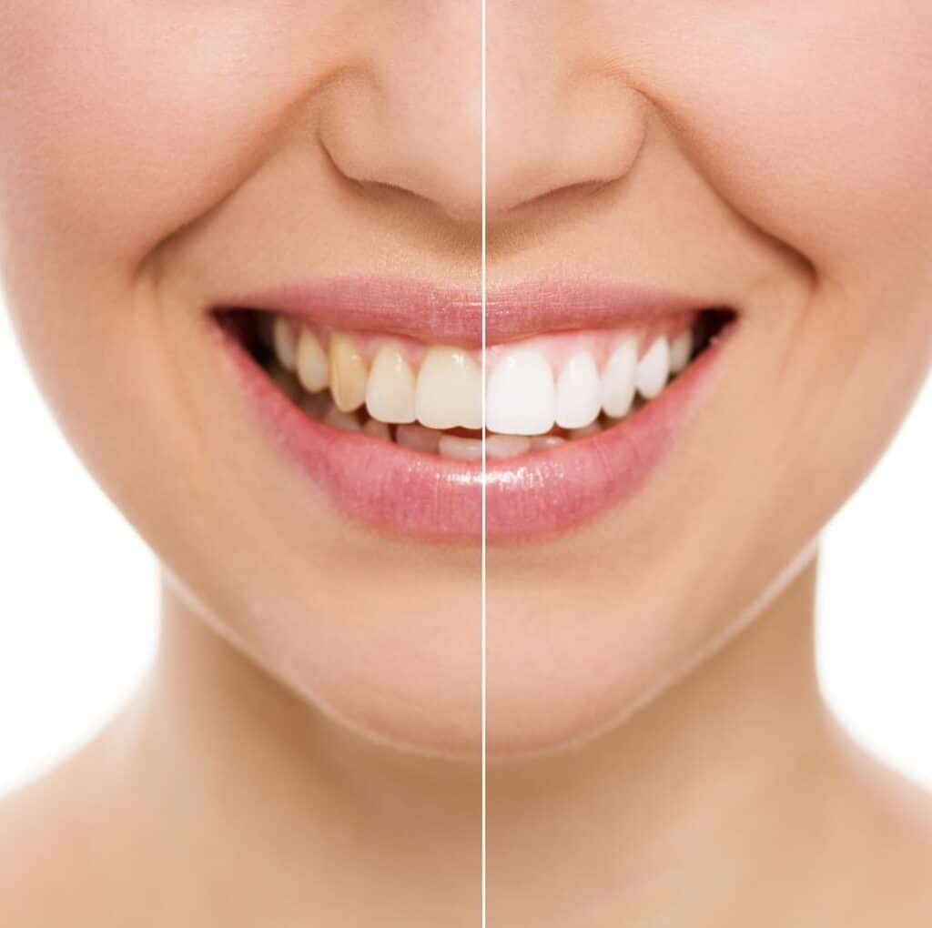 Before and after shots of teeth whitening treatment.