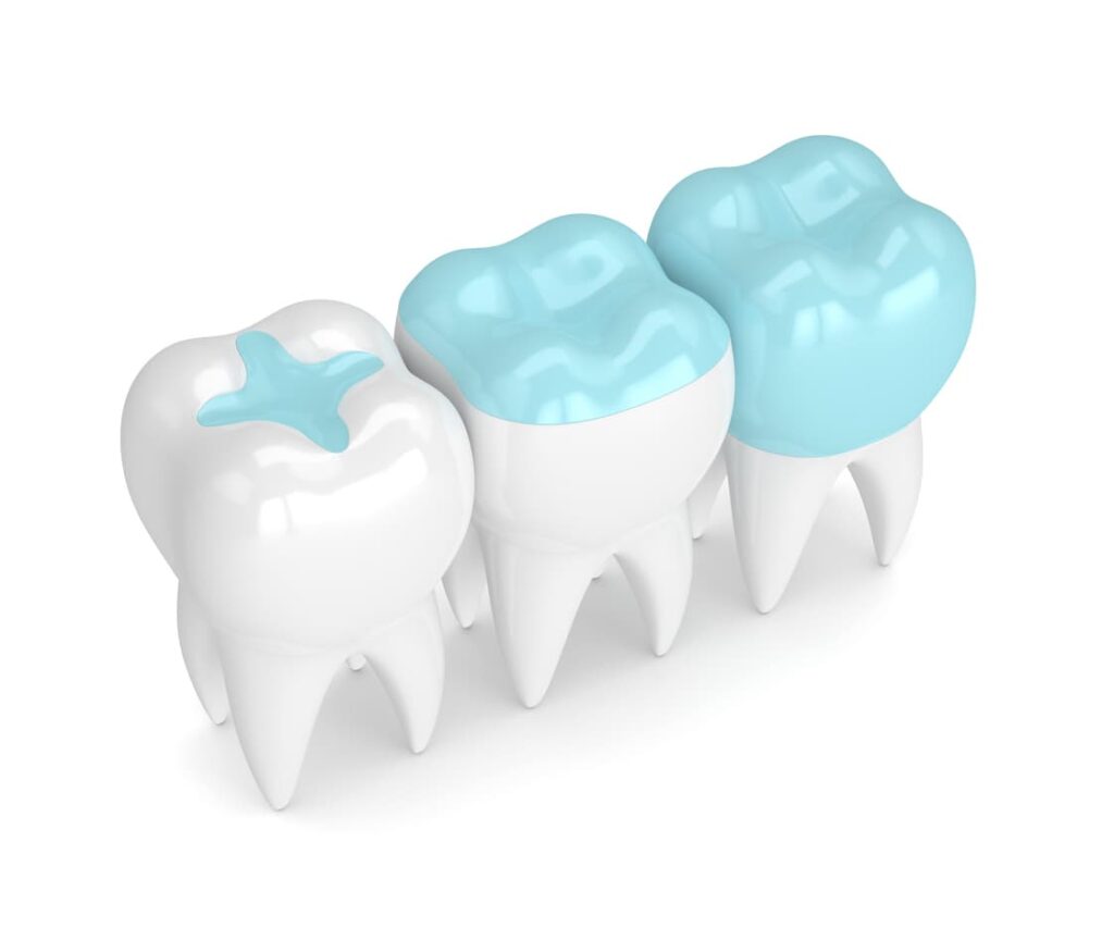 3d image of dental sealant & fillers