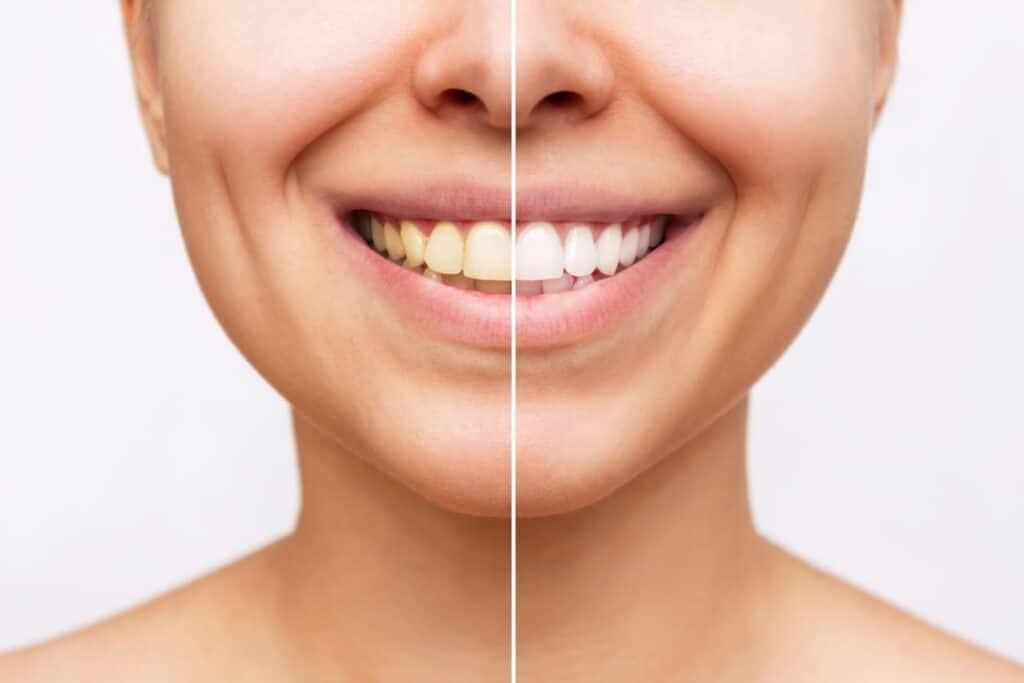 A before and after shot of a tooth whitening procedure in Henderson, NV.