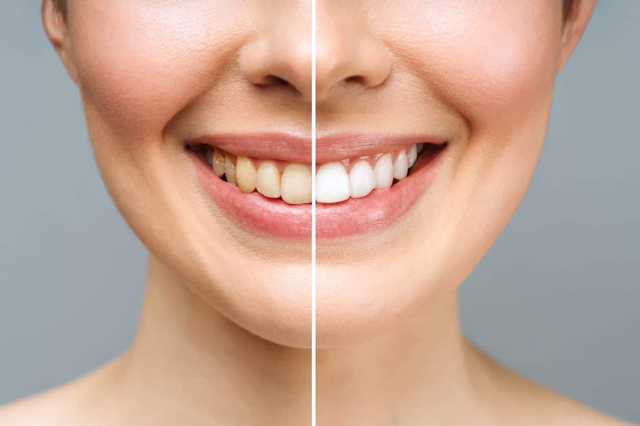 A before and after shot of a tooth whitening procedure in Henderson, NV.
