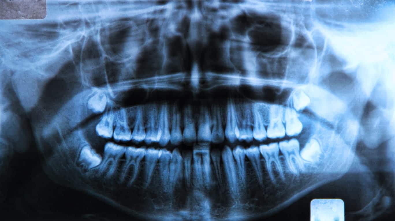 An X-ray showing impacted wisdom teeth.