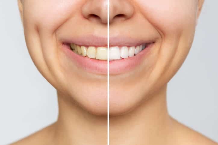 A before-and-after photo of a woman's smile after having her teeth whitened. 