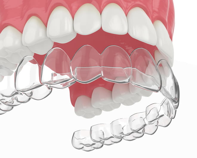 A 3D rendering of an Essix retainer going over teeth. 