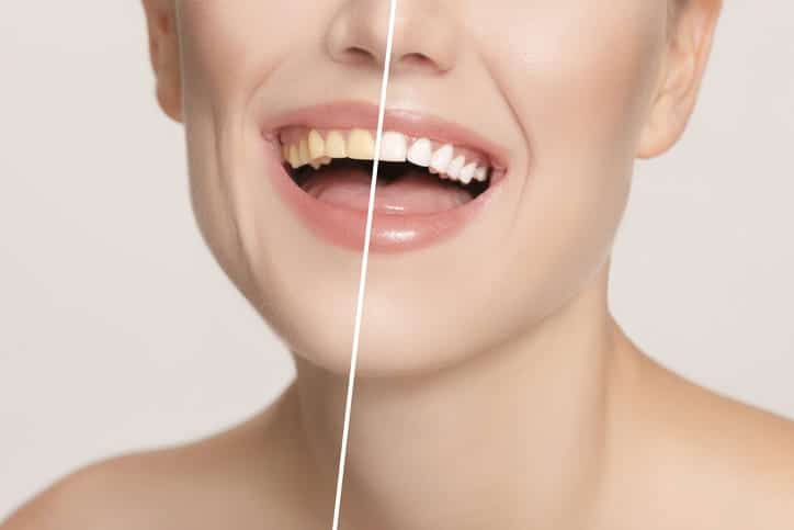 A before-and-after photo of a woman's smile after having her teeth whitened. 
