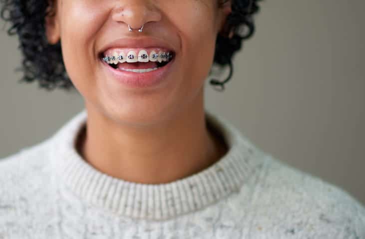 Focus is on a person smiling with metal braces. 