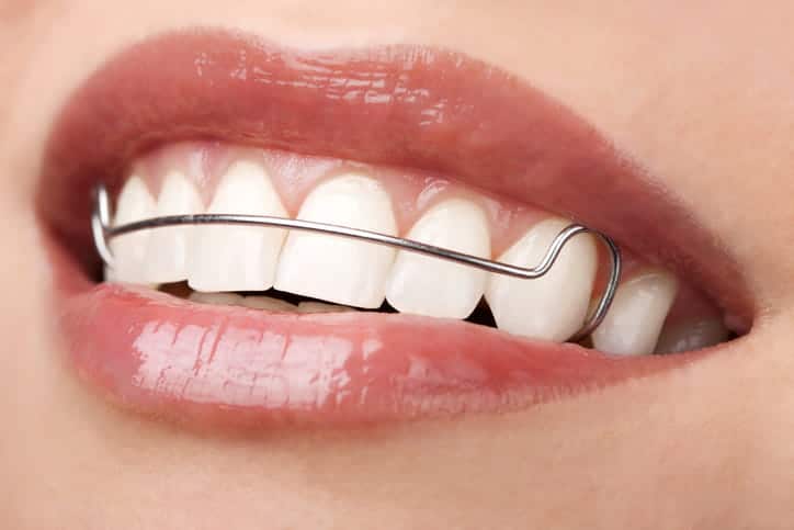 Focus is on a woman's smile while wearing a metal retainer.