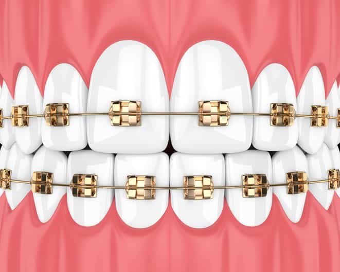 A graphic showing what gold-plated braces look like while applied to teeth.