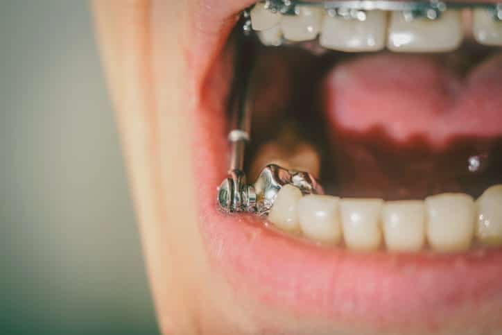 Focus is on a Herbst appliance inside a person's mouth.