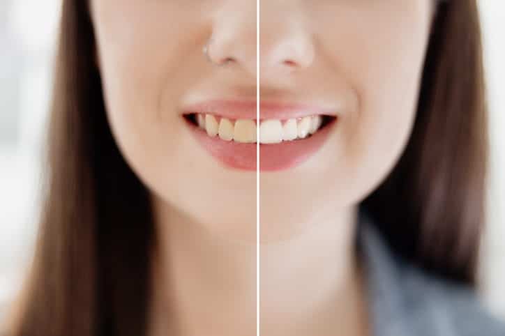 Before and after photos from teeth whitening.