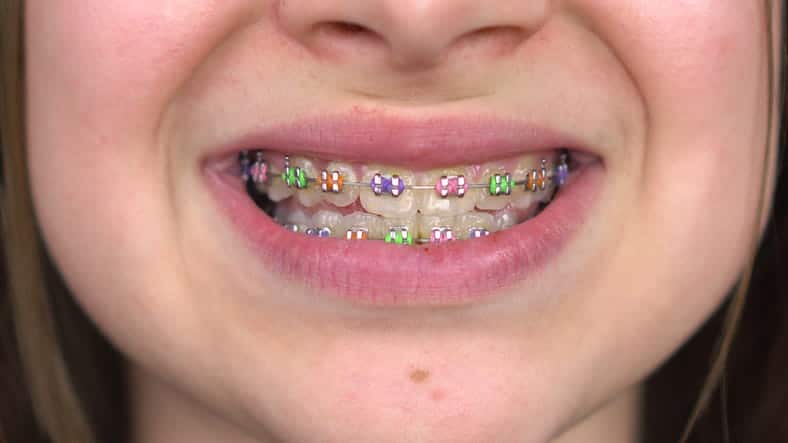 Focus is on a child smiling with metal braces.