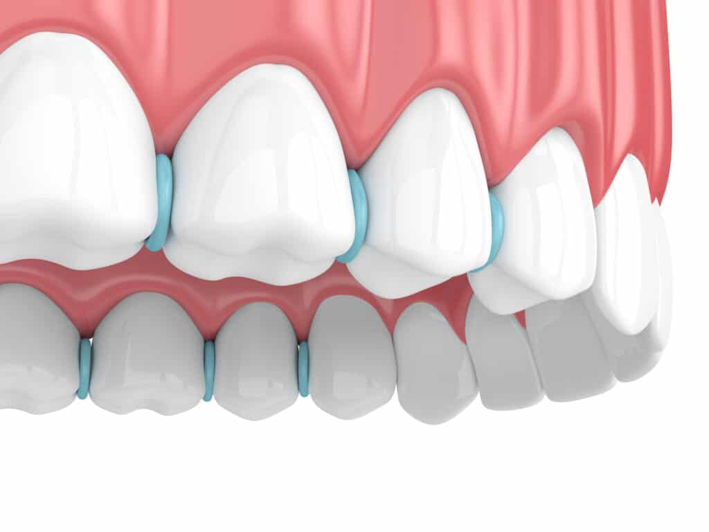 3d render of rubber separators between teeth