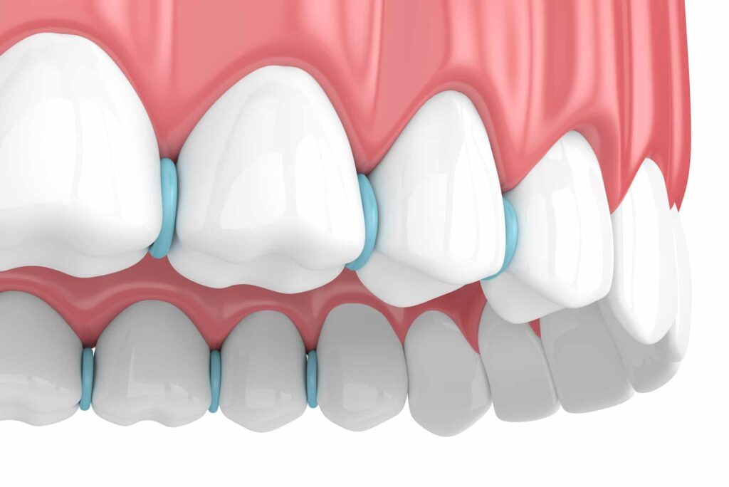 3d render of rubber separators between teeth