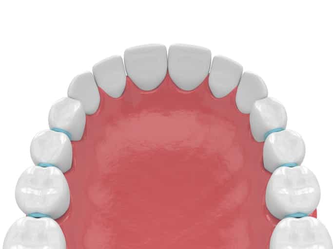 A 3D rendering of dental separators between teeth. 