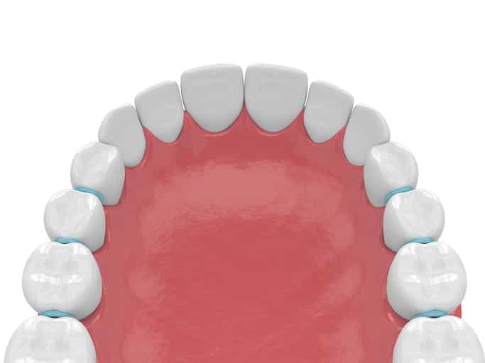A 3d rendering of dental separators between teeth.