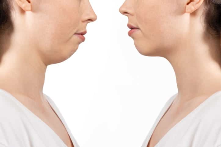 A before-and-after picture of an overbite correction.