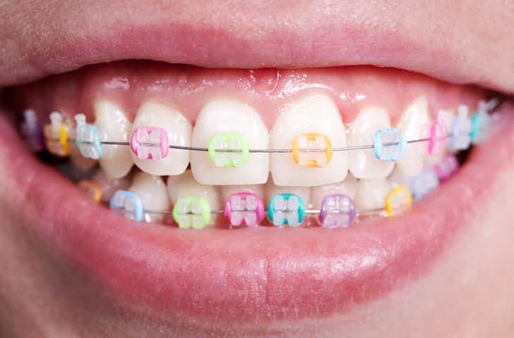 Focus is on a person's smile with metal braces. 