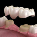 A 3D rendering of a dental bridge covering teeth.