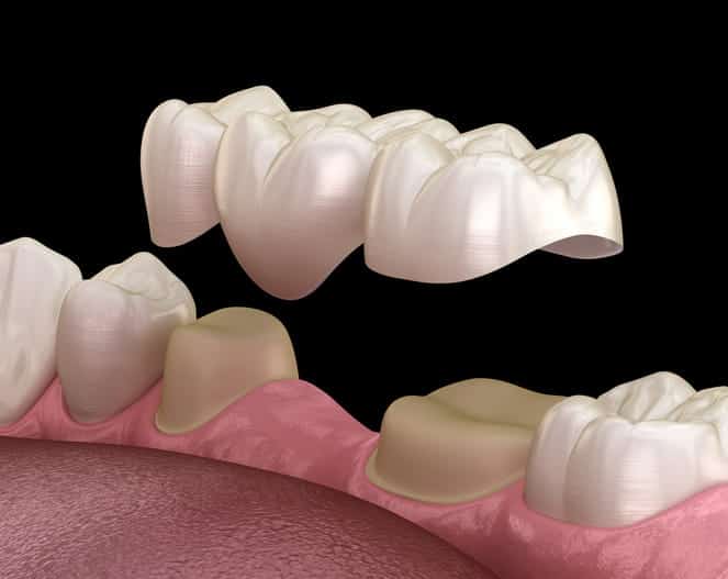 A 3D rendering of a dental bridge covering teeth. 