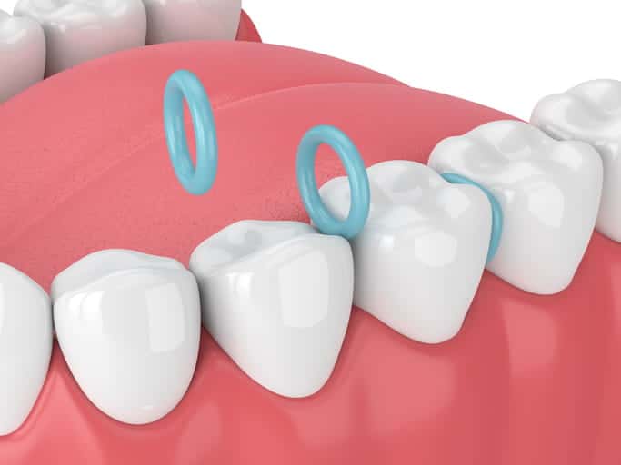 A 3D rendering of dental separators between teeth.